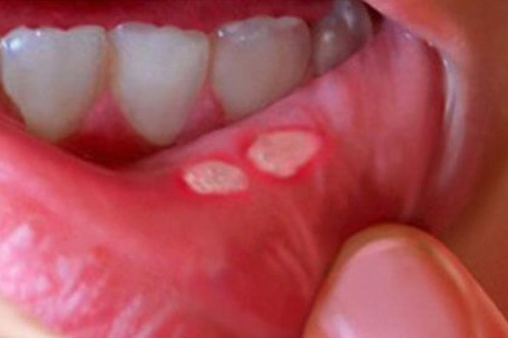 TRPJELA BOLOVE ZBOG AFTE U USTIMNA PA… Sve više oboljelih mladih ljudi – djevojci ODSEKLI JEZIK, a imala 1 SIMPTOM - featured image TRPJELA BOLOVE ZBOG AFTE U USTIMNA PA… Sve više oboljelih mladih ljudi – djevojci ODSEKLI JEZIK, a imala 1 SIMPTOM - featured image