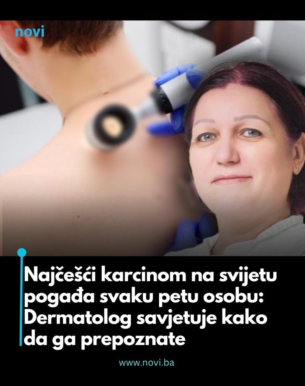 Najčešći karcinom na svijetu pogađa svaku petu osobu: Dermatolog savjetuje kako da ga prepoznate - featured image