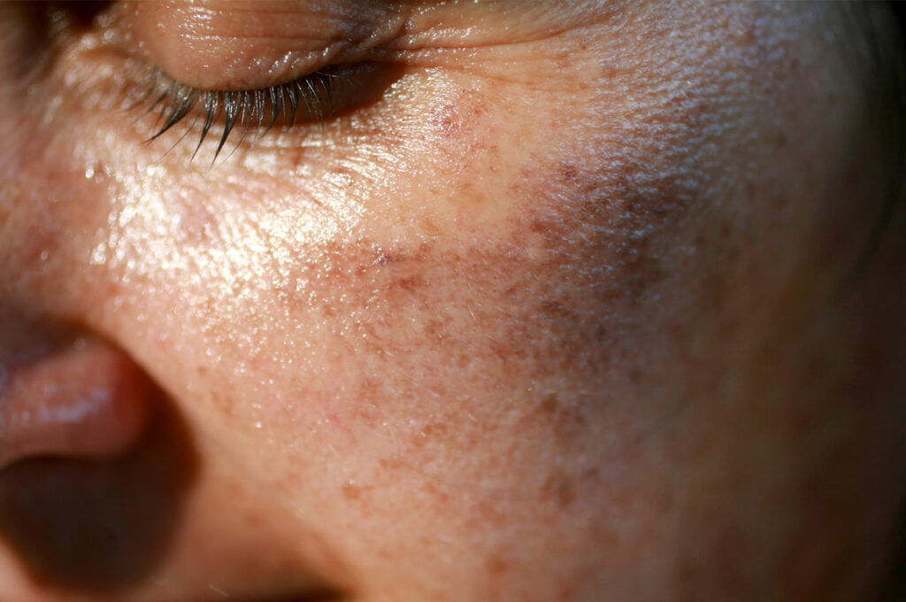 MAZALA JE LICE SA OVIM, STARAČKE PJEGE SU NESTALE: Ovako se zauvijek riješite SMEĐIH MRLJA sa kože, savjetuje poznati dermatolog - featured image MAZALA JE LICE SA OVIM, STARAČKE PJEGE SU NESTALE: Ovako se zauvijek riješite SMEĐIH MRLJA sa kože, savjetuje poznati dermatolog - featured image