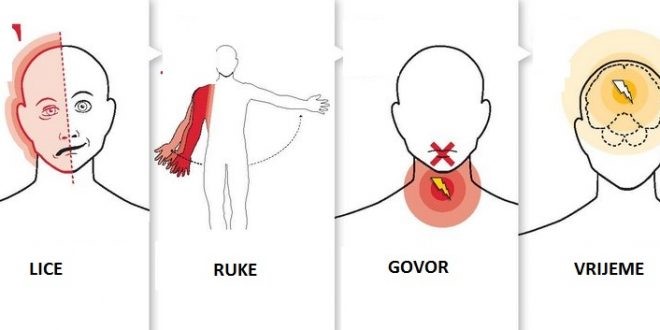 VUKOSAVA JE 2 PUTA IMALA MOŽDANI UDAR, sada je opisala SIMPTOME: “Evo šta sam prvo osjetila…” - featured image VUKOSAVA JE 2 PUTA IMALA MOŽDANI UDAR, sada je opisala SIMPTOME: “Evo šta sam prvo osjetila…” - featured image
