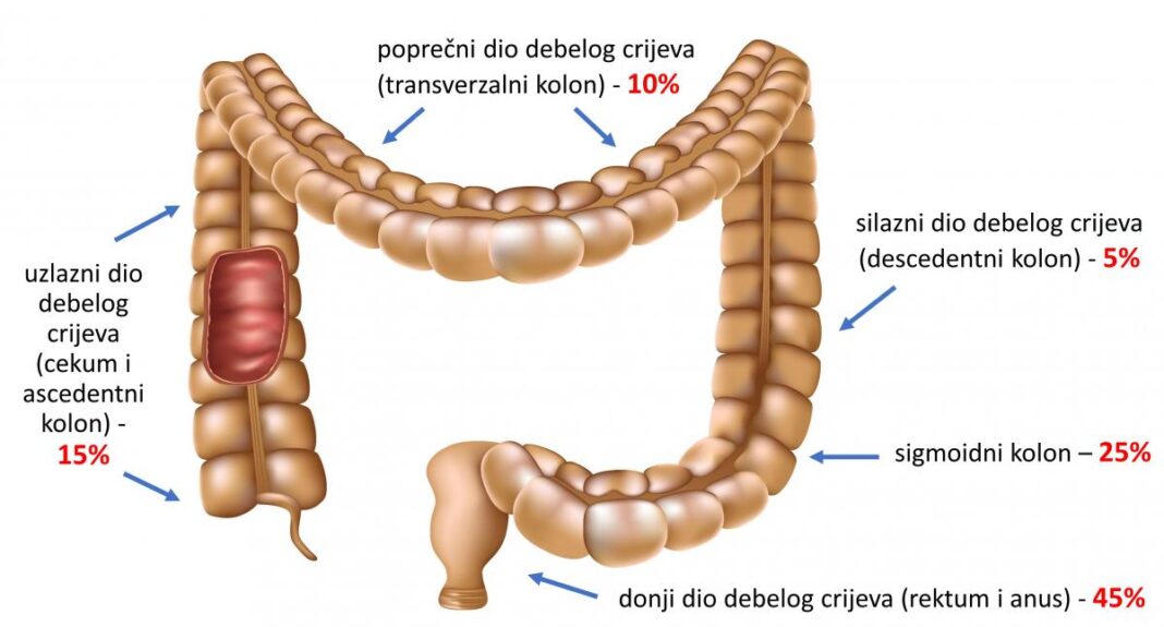 Mislila je da ulazi u menopauzu, a onda je saznala da ima rak debelog crijeva: to su bili prvi simptomi koje je osjetila - featured image