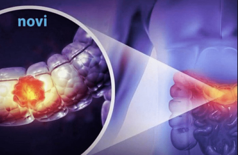 Čak 91 % veći rizik od raka debelog crijeva: Ova navika može vas skupo stajati! - featured image Čak 91 % veći rizik od raka debelog crijeva: Ova navika može vas skupo stajati! - featured image