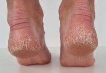 Jeftino čudo iz kuhinje koje spašava vaša stopala: Kao rukom rješava ispucale peta, gljivice i kurje oči Jeftino čudo iz kuhinje koje spašava vaša stopala: Kao rukom rješava ispucale peta, gljivice i kurje oči - featured image