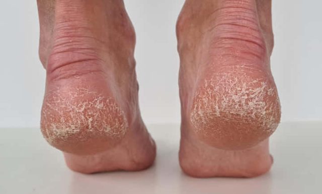 Jeftino čudo iz kuhinje koje spašava vaša stopala: Kao rukom rješava ispucale peta, gljivice i kurje oči - featured image Jeftino čudo iz kuhinje koje spašava vaša stopala: Kao rukom rješava ispucale peta, gljivice i kurje oči - featured image