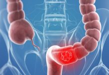 Tihi signali opake bolesti: Ovo su 4 znaka raka debelog crijeva koje tijelo šalje mjesecima prije Tihi signali opake bolesti: Ovo su 4 znaka raka debelog crijeva koje tijelo šalje mjesecima prije - featured image