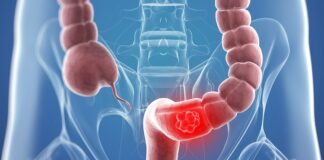 Tihi signali opake bolesti: Ovo su 4 znaka raka debelog crijeva koje tijelo šalje mjesecima prije Tihi signali opake bolesti: Ovo su 4 znaka raka debelog crijeva koje tijelo šalje mjesecima prije - featured image