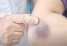 NIKAD NE BISTE POGODILI ZAŠTO SE MODRICE JAVLJAJU PO TIJELU: Nema Veze Sa POVREDAMA, PRAVI RAZLOG ĆE VAS ŠOKIRATI NIKAD NE BISTE POGODILI ZAŠTO SE MODRICE JAVLJAJU PO TIJELU: Nema Veze Sa POVREDAMA, PRAVI RAZLOG ĆE VAS ŠOKIRATI - featured image