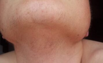 EVO ZAŠTO ŽENE IMAJU DLAKAVU BRADU! Ovo vam organizam govori! EVO ZAŠTO ŽENE IMAJU DLAKAVU BRADU! Ovo vam organizam govori! - featured image