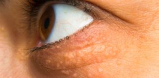 STAVILA SAM OVU NAMIRNICU NA MASNO TKIVO KOD OKA, ono je preko noći nestalo: EVO ŠTA ME SPASILO, SVI GA IMATE U KUĆI STAVILA SAM OVU NAMIRNICU NA MASNO TKIVO KOD OKA, ono je preko noći nestalo: EVO ŠTA ME SPASILO, SVI GA IMATE U KUĆI - featured image