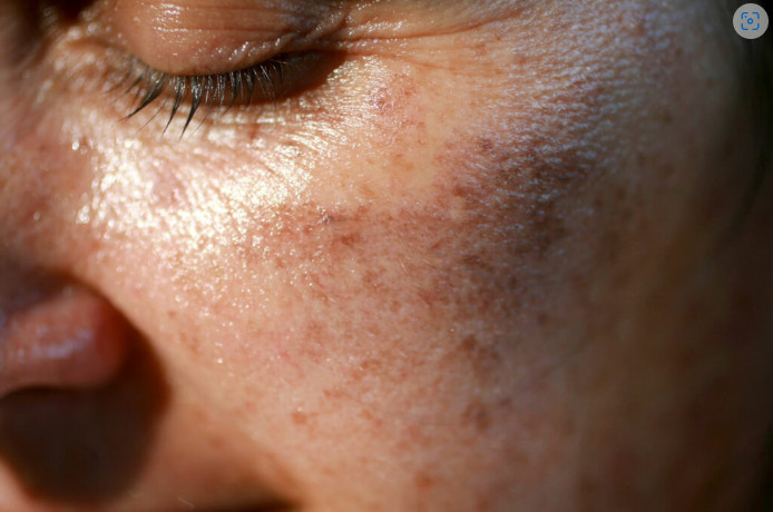 MAZALA JE LICE SA OVIM, STARAČKE PJEGE SU NESTALE: Ovako se zauvijek riješite SMEĐIH MRLJA sa kože, savjetuje poznati dermatolog - featured image MAZALA JE LICE SA OVIM, STARAČKE PJEGE SU NESTALE: Ovako se zauvijek riješite SMEĐIH MRLJA sa kože, savjetuje poznati dermatolog - featured image