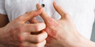 KOŽA otkriva da imate DIJABETES : Simptomi koje ne smijete ignorirati! KOŽA otkriva da imate DIJABETES : Simptomi koje ne smijete ignorirati! - featured image