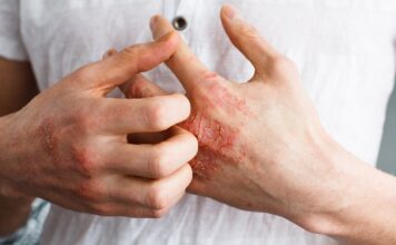 KOŽA otkriva da imate DIJABETES : Simptomi koje ne smijete ignorirati! KOŽA otkriva da imate DIJABETES : Simptomi koje ne smijete ignorirati! - featured image