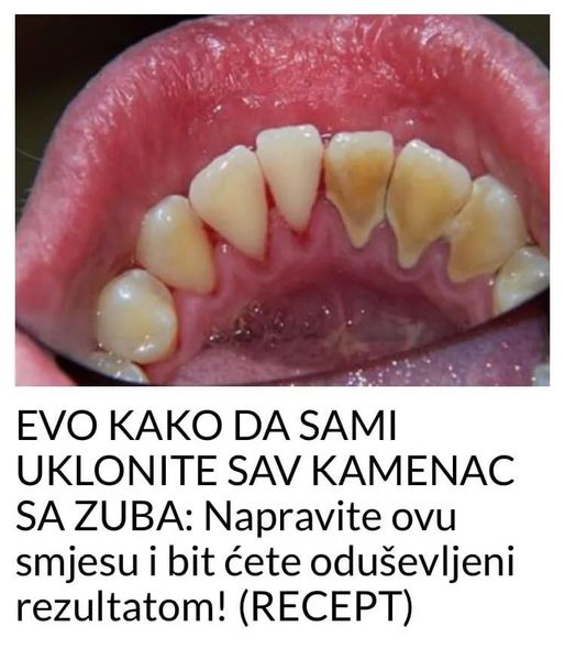 EVO KAKO DA SAMI UKLONITE SAV KAMENAC SA ZUBA: Napravite Ovu Smjesu I Bit Ćete Oduševljeni Rezultatom! (RECEPT) - featured image EVO KAKO DA SAMI UKLONITE SAV KAMENAC SA ZUBA: Napravite Ovu Smjesu I Bit Ćete Oduševljeni Rezultatom! (RECEPT) - featured image