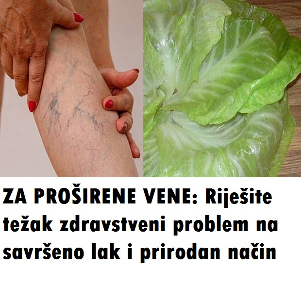 ZA PROŠIRENE VENE: Riješite težak zdravstveni problem na savršeno lak i prirodan način - featured image