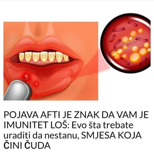 POJAVA AFTI JE ZNAK DA VAM JE IMUNITET LOŠ: Evo šta trebate uraditi da nestanu, SMJESA KOJA ČINI ČUDA - featured image POJAVA AFTI JE ZNAK DA VAM JE IMUNITET LOŠ: Evo šta trebate uraditi da nestanu, SMJESA KOJA ČINI ČUDA - featured image