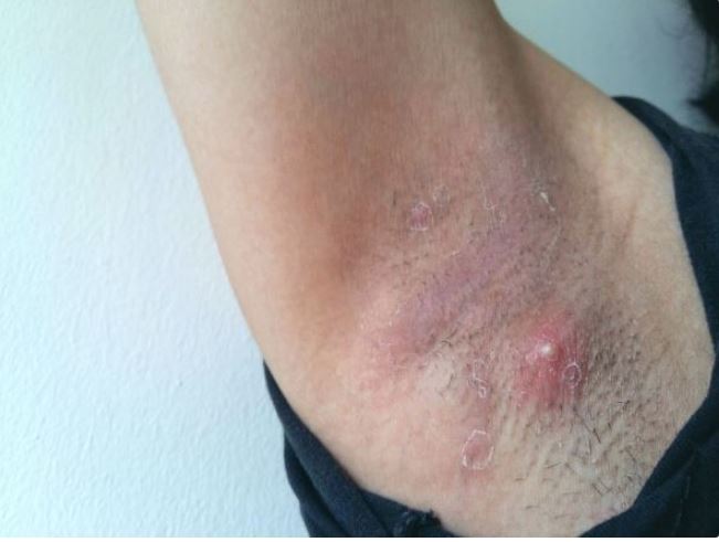 LJUDI SE NE PERU ISPOD PAZUHA KAKO TREBA: Stručnjak za higijenu savetuje čime da izlečite bubuljice i uklonite znoj - featured image LJUDI SE NE PERU ISPOD PAZUHA KAKO TREBA: Stručnjak za higijenu savetuje čime da izlečite bubuljice i uklonite znoj - featured image