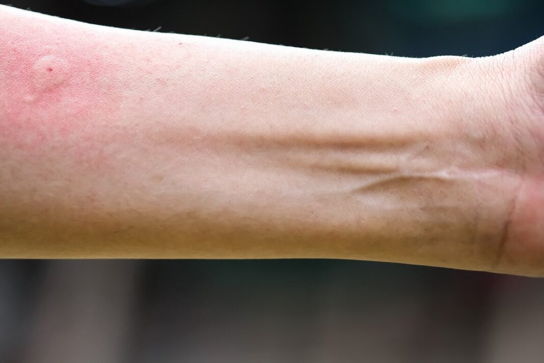 Ubod stršljena ga odveo na rub smrti,Ispovijest muškarca kojeg je napao roj stršljena ledi krv u žilama: “Srce mi je prestalo kucati, ali čudo me vratilo! - featured image Ubod stršljena ga odveo na rub smrti,Ispovijest muškarca kojeg je napao roj stršljena ledi krv u žilama: “Srce mi je prestalo kucati, ali čudo me vratilo! - featured image