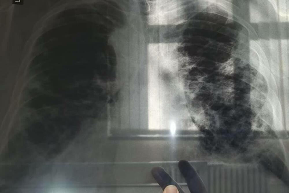 OVO JE PRVI SIMPTOM RAKA PLUĆA, A NIJE KAŠALJ: Većina ljudi ga nikad ne poveže sa ovom opakom bolešću! - featured image OVO JE PRVI SIMPTOM RAKA PLUĆA, A NIJE KAŠALJ: Većina ljudi ga nikad ne poveže sa ovom opakom bolešću! - featured image