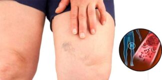 Simptomi krvnih ugrušaka u tijelu: Ako to primijetite, odmah potražite medicinsku pomoć Simptomi krvnih ugrušaka u tijelu: Ako to primijetite, odmah potražite medicinsku pomoć - featured image